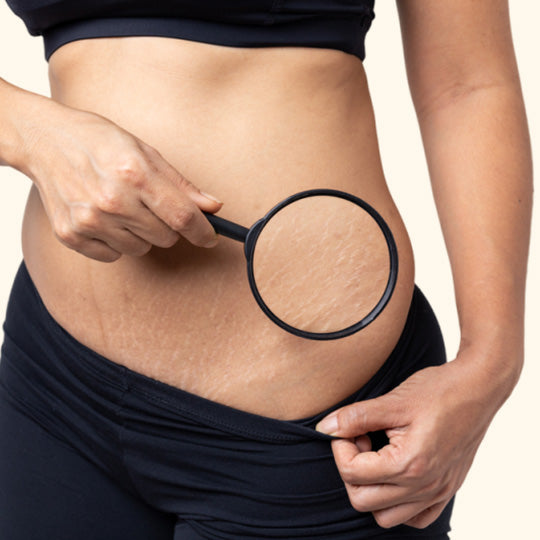 Anti Stretch Marks Extract Oil Blend
